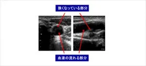 頚動脈エコー