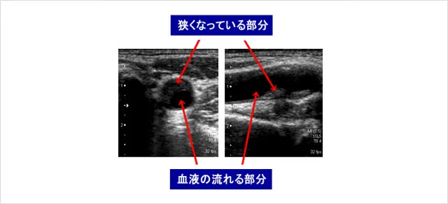 頚動脈エコー